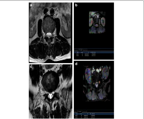 Fig. 3 MRI T2W image of cauda equina (mapping and FA values were calculated (resonance imaging,a) and FA mapping of DTI of cauda equina (b)