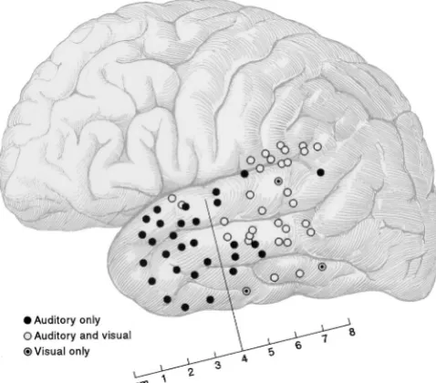 Figure. Topographic distribution of naming sites acrosspatients indicating whether auditory, visual, or both audi-tory and visual naming were disrupted duringstimulation.