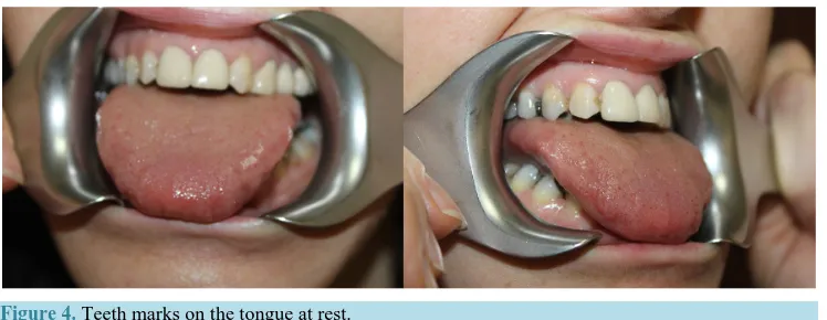 Figure 4. Teeth marks on the tongue at rest.                                                 