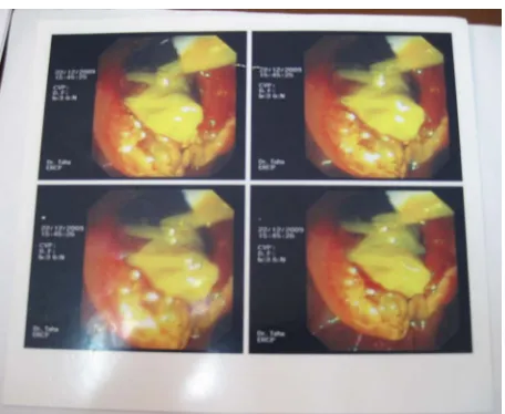 Table 2, shows that the main presenting feature was jaundice being present in all 12 cases (100%) this is ei-jaundicecases (25%)