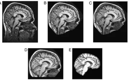 Fig 1: Typical MRI data set. (A) Individual scan before defacing. (B) Same scan after defacing