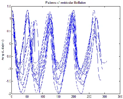 Fig. 7 Patterns of VF (record cu01 of CUDB database) 