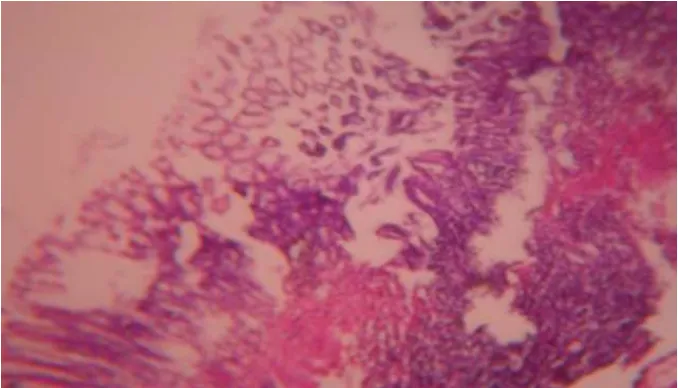 Fig.1: Photomicrograph of gastric mucosa showed sever mucous degeneration, necrosis,  sloughing and sever accumulation of the inflammatory cells in submucosal, of fasting rat treated with aqueous oral suspension of aspirin at dose 150mg/kg  (H&E stain), X1