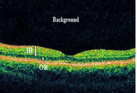 Fig  2:  A retinal OCT image with the labels indicating two main retinal layers 