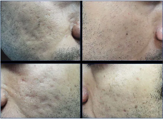 Figure 1. A patient with acne scars before and six months after subcision.     
