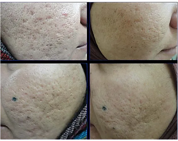 Figure 2. Patient with rolling acne scar before and six months after sub cision.    