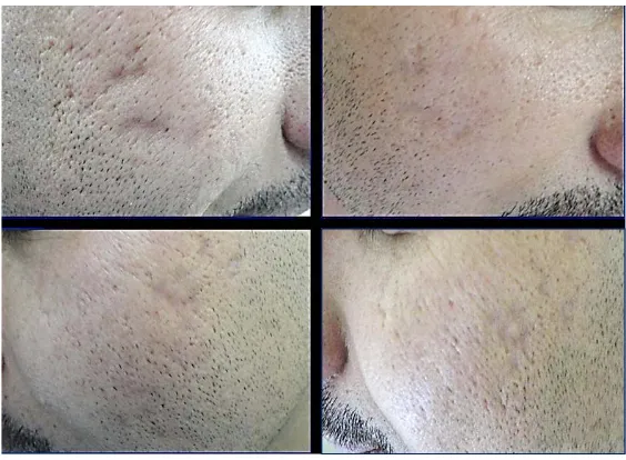 Figure 4. A patient with rolling & icepick acne scars before and six months after subcision