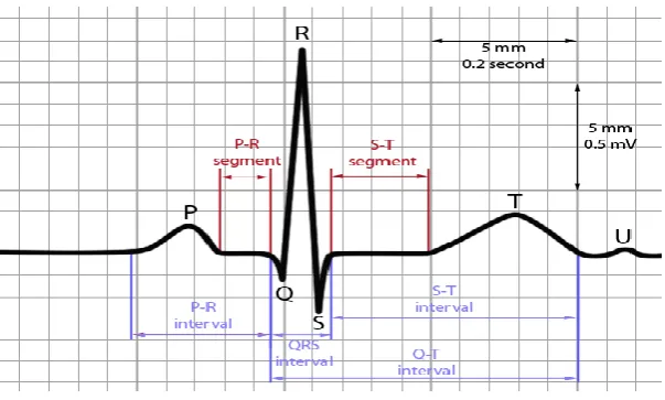 FIGURE 1: Normal ECG waveform 