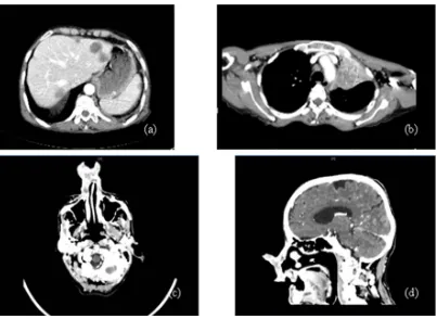Figure 2. (a) CT scan abdomen showing liver and spleen metastasis; (b) CT scan chest showing left lung mass with mediatstinal metastasis; (c) & (d) Horizontal and sagital sections CT scan facial bones showing the tumour