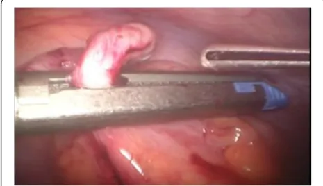 Fig. 2 Closing of the appendicular stump with the application oftitanium endoclip