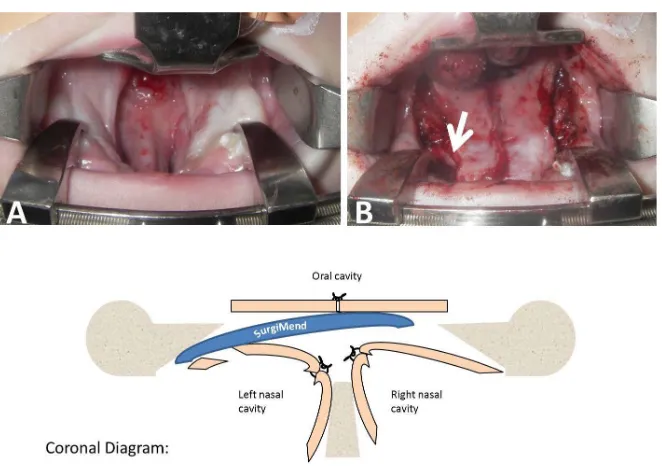 Figure 3. Reinforcement of a tenuous cleft palate repair in subject 4, using a sheet of acel-lular fetal bovine dermal matrix as an interposition graft