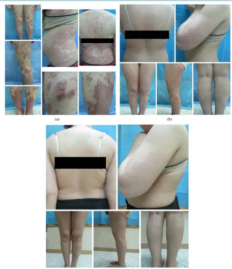 Figure 3. Thirty year old female with generalized pustular psoriasis for 5 years. (a) Before treatment; (b) after 14 weeks of treatment; (c) after 30 weeks of treatment