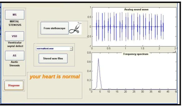 Fig 1: System Output for “normal heart”. 