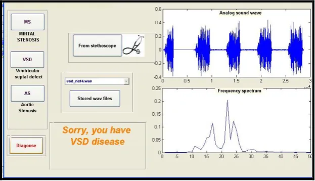 Fig 2:  System Output for up-normal heart “arterial stenosis”. 