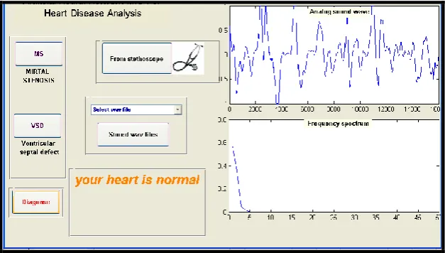 Fig 5:  System Output for “aortic stenosis” heart disease. 