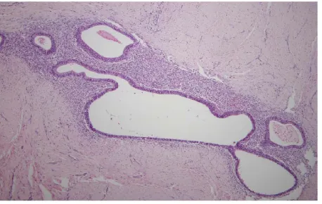 Figure 2. Microscopic findings. 40× view of surgical speci-men revealing endometriosis