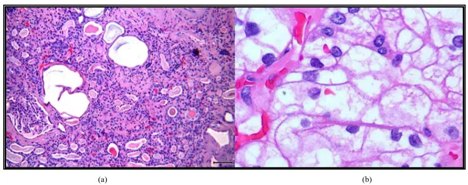 Figure 1. (a) A representative example of a polycystic kidney composed of cysts in different sizes (hematoxylin and eosin staining; ×100); (b) Renal cell carcinoma with pleomorphic nuclei removed from a tumor nodule in the same kidney speci-men as shown in