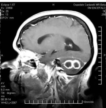 Figure 1. Canal bone and mastoid destruction.      