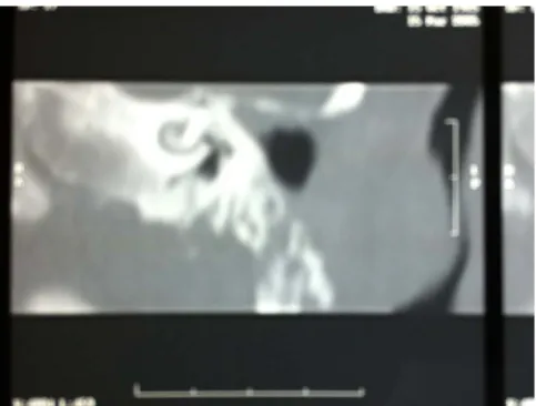 Figure 4. Two nodules in the left cerebellar hemisphere.         