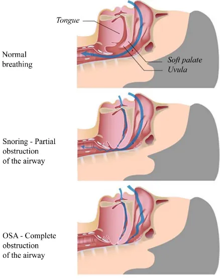 Figure 1. Obstructive sleep apnea (OSA) is characterized by repetitive episodes of complet (apnea) or parcial (hypopnea) upper airway in obstructive sleep apnea occurring during sleep