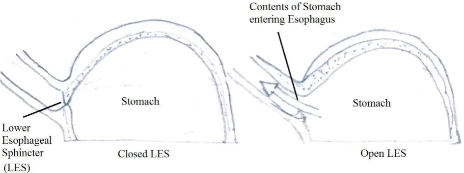Fig.1 Closed LES and Open LES situation.  
