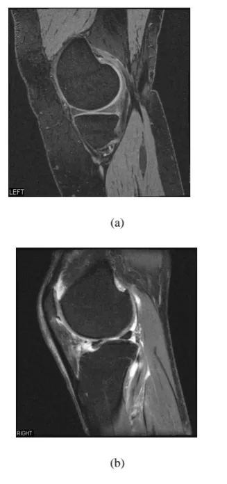Fig. 3. MR image of (a) Normal knee joint (b) OA affected knee joint 