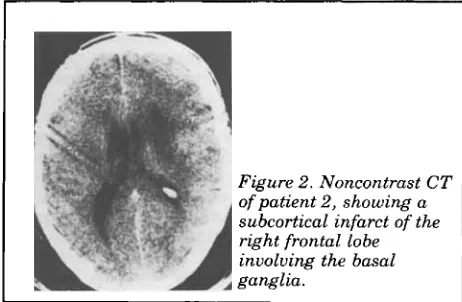 Figure 2. Noncontrast CT of patient 2, showing a 