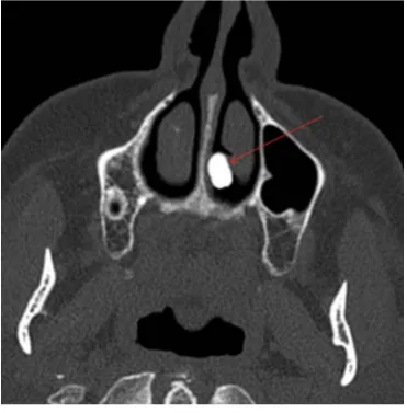 Figure 1. Radiopaque lesion visualized on coron-al CT imaging. Red arrow indicating the radi-opaque lesion