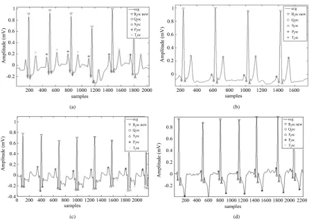 Figure 7. (a) Algorithm result on record 101.dat from MIT-BIH Database; (b) Algorithm result on record 201.dat from MIT-BIH Database; (c) Algorithm result on record 100.dat from MIT-BIH Database; (d) Algorithm result on record 219.dat from MIT-BIH Database