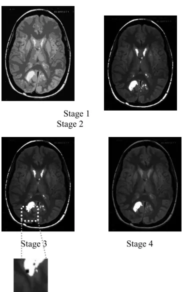 Figure 1: Overview of the Automatic Brain Tumor Segmentation Technique 