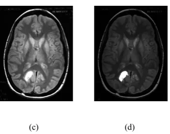 Figure 3: (a),(c)-Original MRI Image, (b), (d)- Brain Tumor Segmentation 