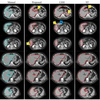 Figure 8. Six examples of liver-segmentation results in axial-images of patient A (phase 0 slice 66), B (phase 20 slices 73 and 83), C (phase 0 slices 94 and 100), D (phase 50 slice 50), which are presented from top to bottom