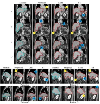 Figure 9. Eight examples of liver-segmentation results: (Top) outlines in coronal images, and (bottom) outlines in sagittal images