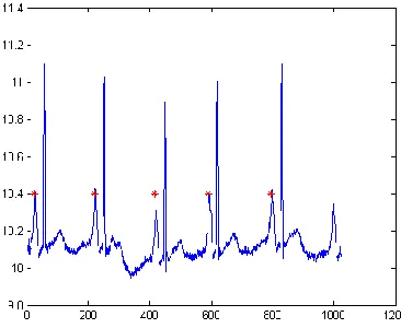 Figure 5 P wave detection (MIT – BIH 223)  