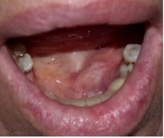 Figure 1. A sialolith which was localized on the left side of the floor of the mouth.                                                        