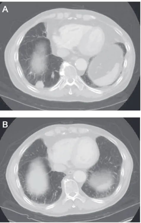 Figure 2 computed tomography image of the brain showing the brain metastasis before treatment (A: March 2007), the good response to whole brain irradiation (B: May 2007), and the complete resolution of the brain disease (C: January 2009).