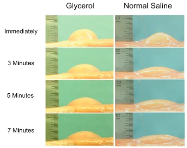 Figure 1 Chronological changes in submucosal elevations after injections of glycerol and normal saline (Sumiyoshi et al 2002)