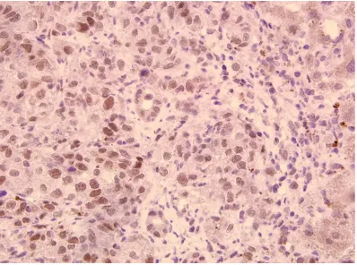 Figure 1. LRP16 expression in poorly differentiated pancreatic ductal adenocarcinomas