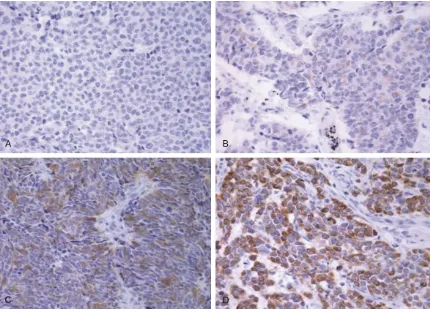 Figure 1. Representative images of RET IHC staining. (A) IHC 0: almost none of the tumor cells had staining; (B) IHC 1+: >10% of the tumor cells had weak staining (C) IHC 2+: >10% tumor cells had moderate staining; (D) IHC 3+: >10% tumor cells had strong staining.