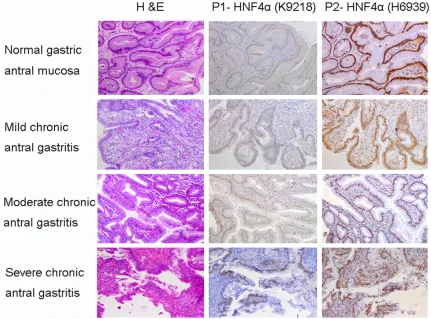Table 3. Correlation between P1-HNF4α protein expression and chronic inflammation in samples without intestinal metaplasia