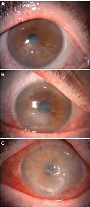 Figure 2 Three-stage classification of neurotrophic keratitis.Note: Stage 1: cloudy and irregular corneal epithelium (A); stage 2: large epithelial defect characterized by smooth edges (B); stage 3: deep corneal ulcer and stromal melting (C).
