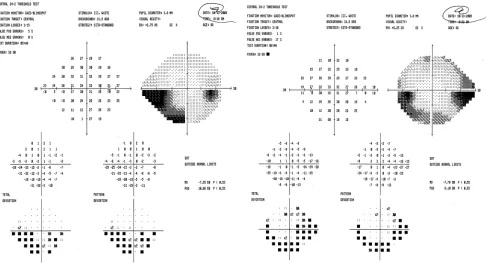 Figure 2 The visual field defect of a patient with NMO, NMOIgG+.Abbreviation: NMO, neuromyleitis optica.