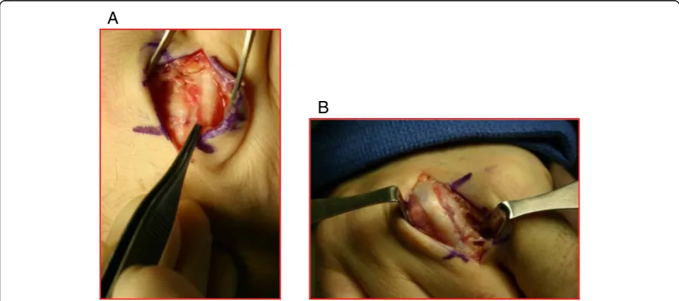 Fig. 12 a Intraoperative findings of a patient with a torn radial sagittal band and ulnarly subluxed EDC tendon before repair b and after repair