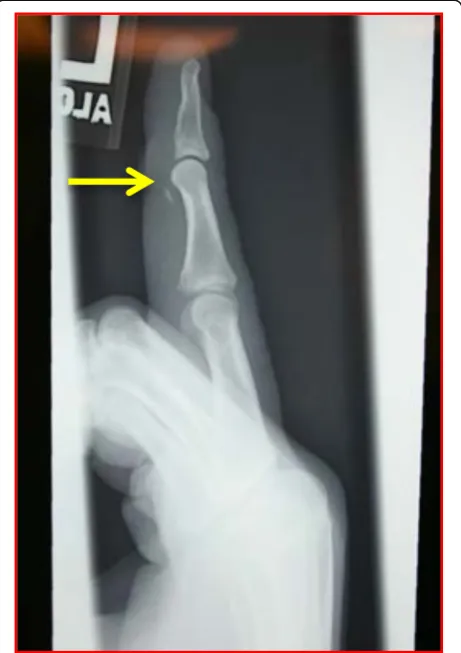 Fig. 13 Lateral radiograph of a ring finger of a patient whose fingergot caught on a basketball net showing an FDP bony avulsionfracture with the fragment caught up distal to the A4 pulley level(yellow arrow)
