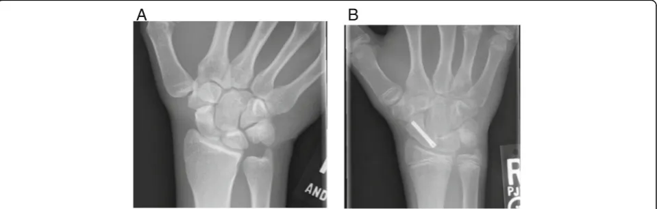 Fig. 1 a PA radiograph of a nondisplaced proximal pole scaphoid fracture in a recreational hockey player