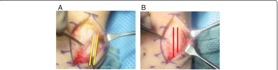 Fig. 3 a Intraoperative finding of a volarly subluxed ECU tendon (between yellow lines) in a recreational tennis player