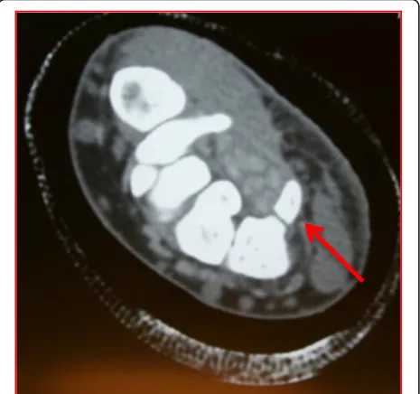 Fig. 6 Axial CT image demonstrating a hook of the hamate fracture(red arrow) in a college hockey player