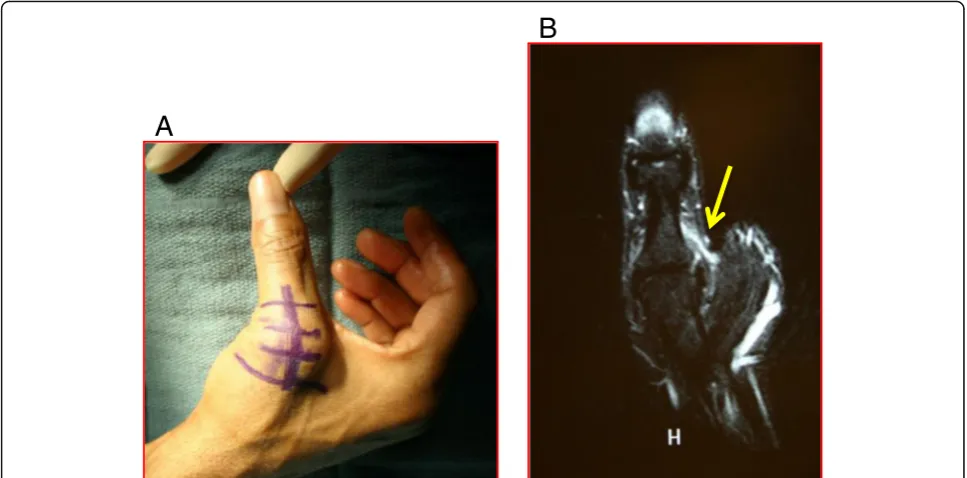 Fig. 7 acoronal sequence demonstrating a complete tear of the UCL which is detached from the proximal phalanx ( Preoperative photograph demonstrating a patient with no endpoint to valgus stress testing of the thumb MCP joint