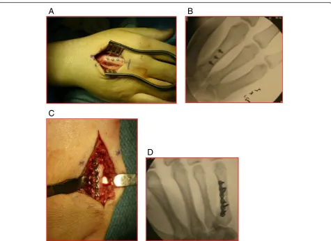 Fig. 8 a Intraoperative and b fluoroscopic images of a long oblique metacarpal shaft fracture secured with three lag screws