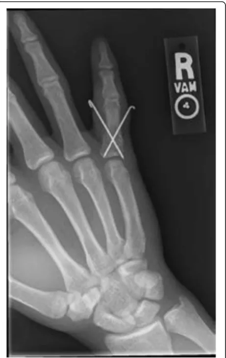 Fig. 10 A PA radiograph of a small finger transverse proximalphalanx fracture with clinical malrotation which was treated withclosed reduction and crossed K-wires